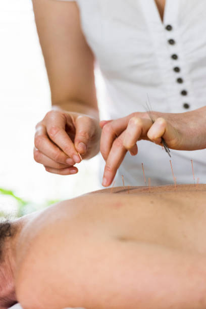 istock Woman having acupuncture treatment 855140004