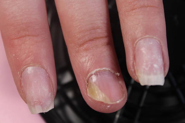 istock The problematic, painful nails of a girl 855898938