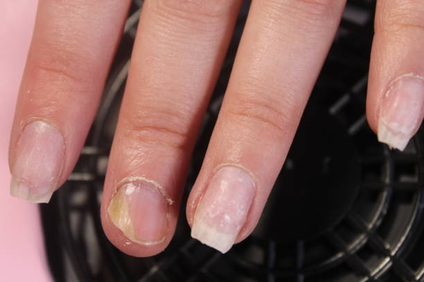 istock The problematic, painful nails of a girl 855902220