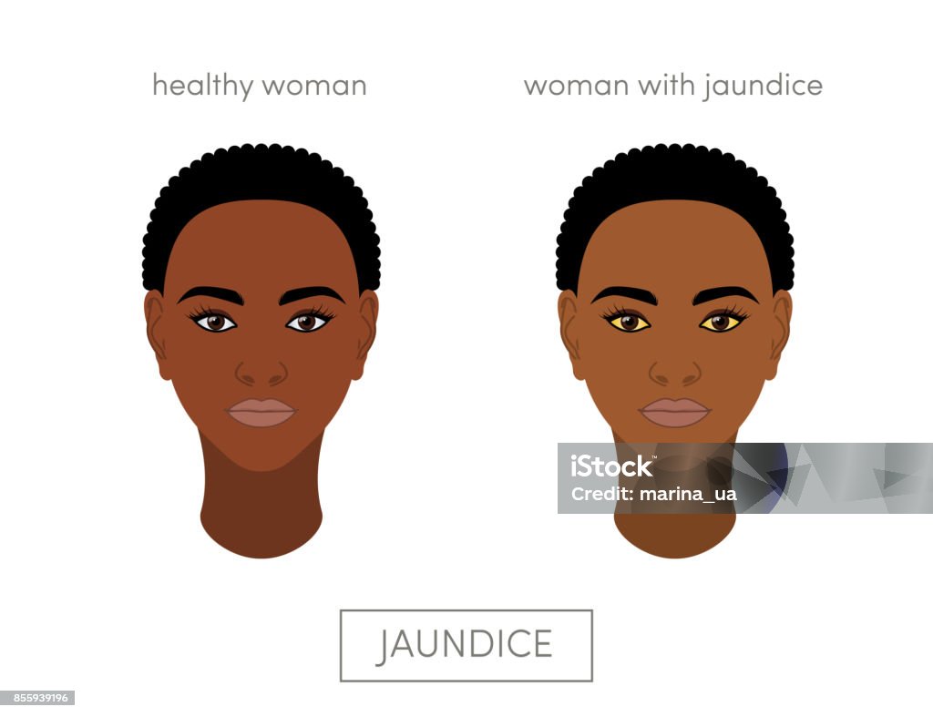 Jaundice Vector Concept Stock Illustration - Download Image Now - Eye,  Infectious Disease, Liver - Organ - iStock