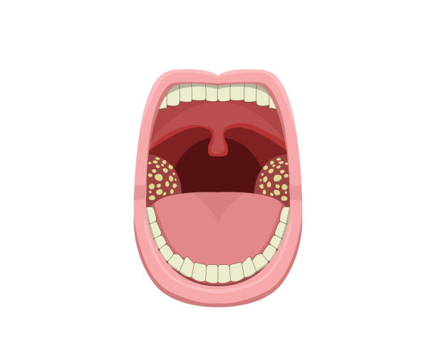 Inflamed Tonsillitis in vector design Inflamed Tonsillitis in vector design. tonsil stock illustrations