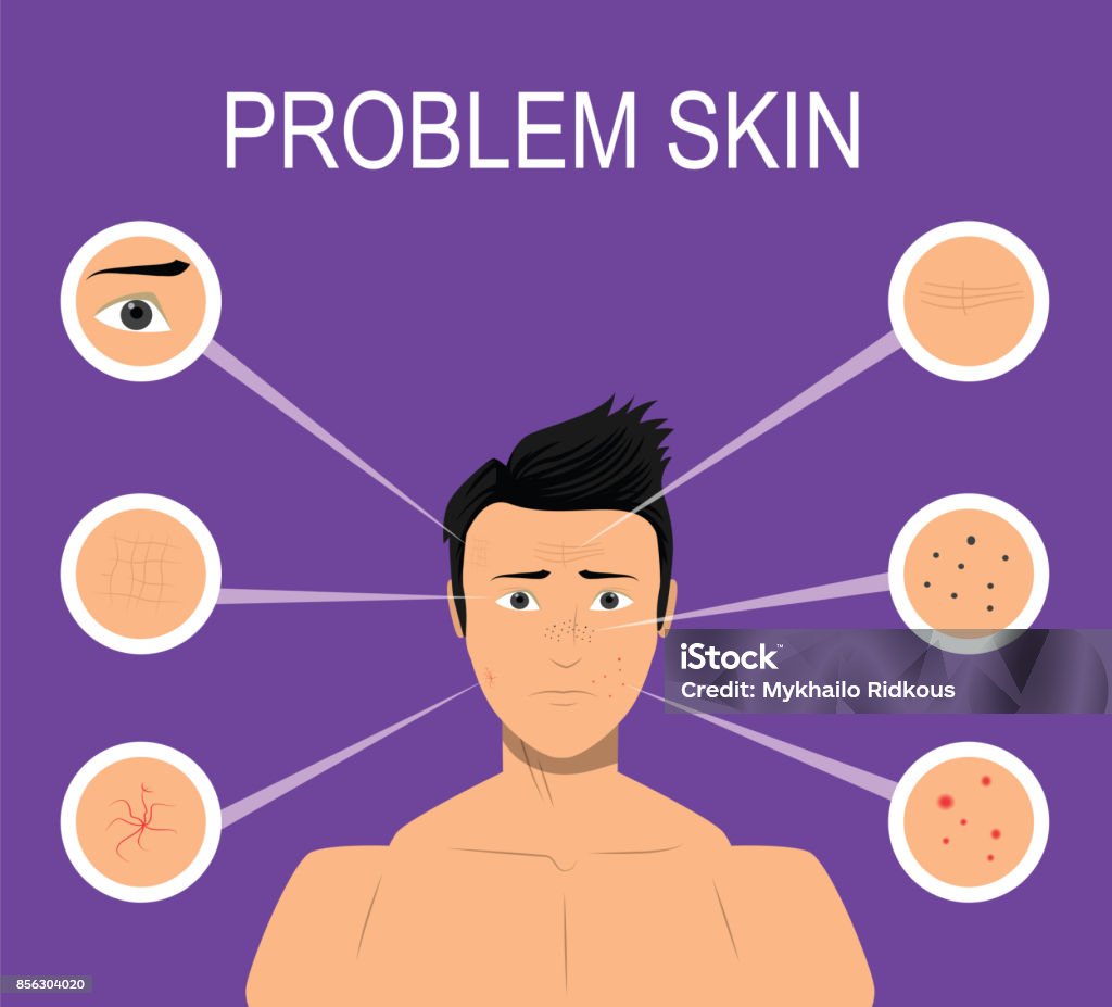 Male with problem skin Male with problem skin such as acne, wrinkles, dark spots. Illustration for cosmetic websites, brochures. Vector Pimple stock vector