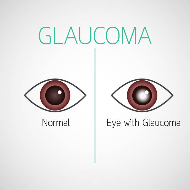 Glaucoma vector icon illustration vector art illustration