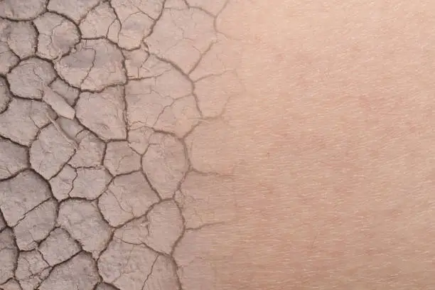 close-up on dry woman skin texture with dry soil