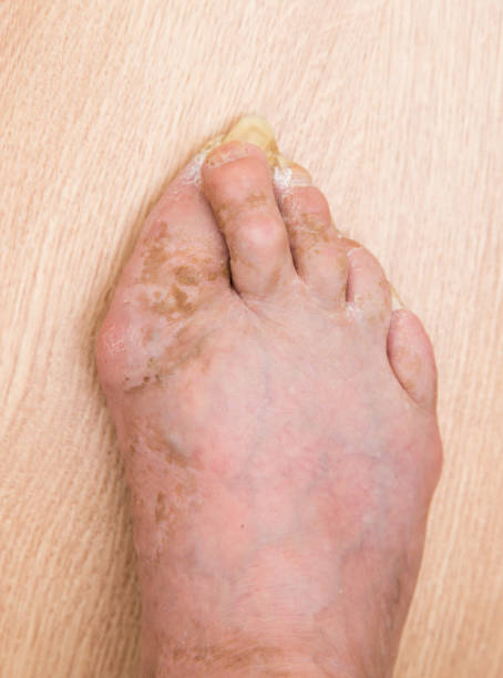 istock Fungus Infection on Nails of Man's Foot 856638838