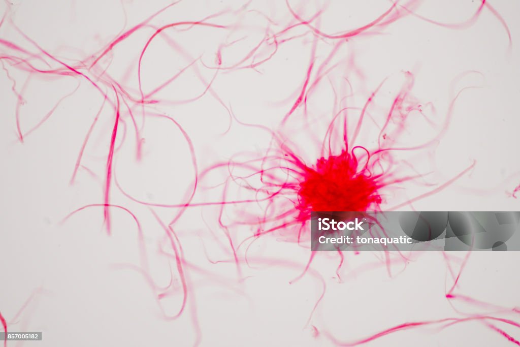 Célula de cáncer en humanos bajo la óptica de microscopio. - Foto de stock de Célula libre de derechos