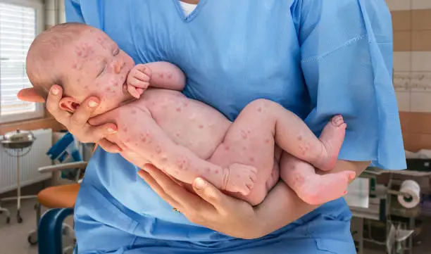Newborn baby with chickenpox, measles or rubella lying in the hands of doctor