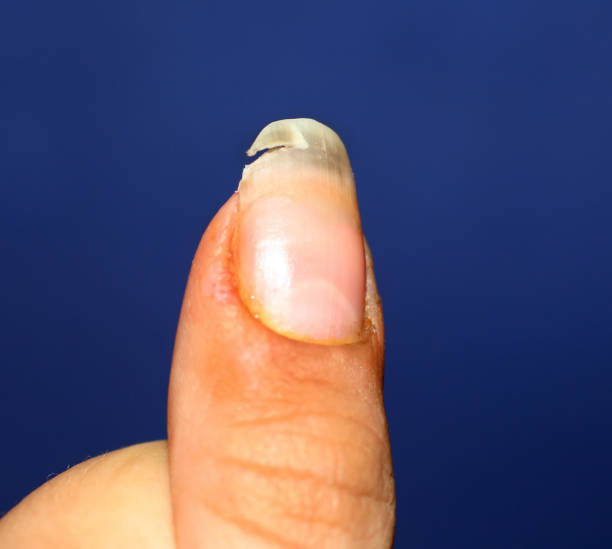 un ongle cassé. manque de vitamines et de calcium dans le corps. - fingernail human finger clean human thumb photos et images de collection