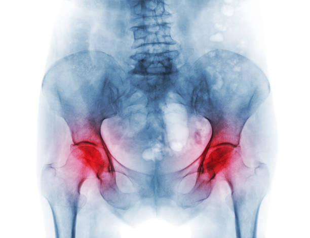 pelvis de radiografía de paciente de osteoporosis y artritis de la película ambos cadera - haunch fotografías e imágenes de stock