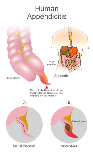Human Appendicitis. A blocked by a piece of stool thereby blocking it is contents from emptying into intestines. Large Intestine system. Illustration human body parts. vector art illustration