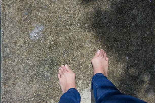 istock Hallux valgus, bunion in foot 858079908