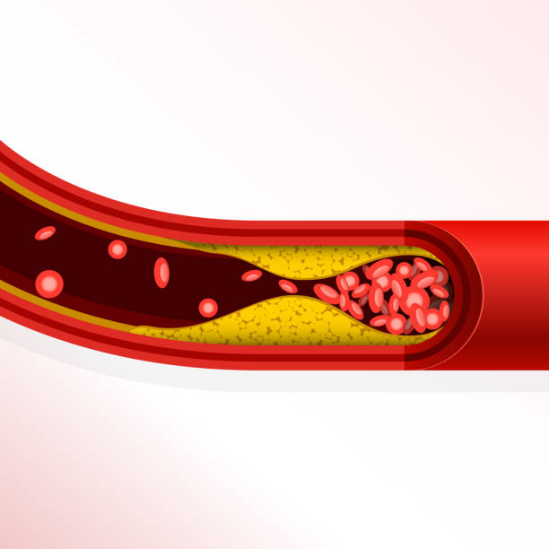 zakrzepica tętnicy - nagromadzenie cholesterolu, miażdżyca - cholesterol atherosclerosis human artery illness stock illustrations