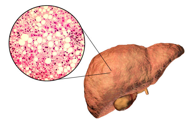 fegato grasso, steatosi epatica - anatomical model immagine foto e immagini stock