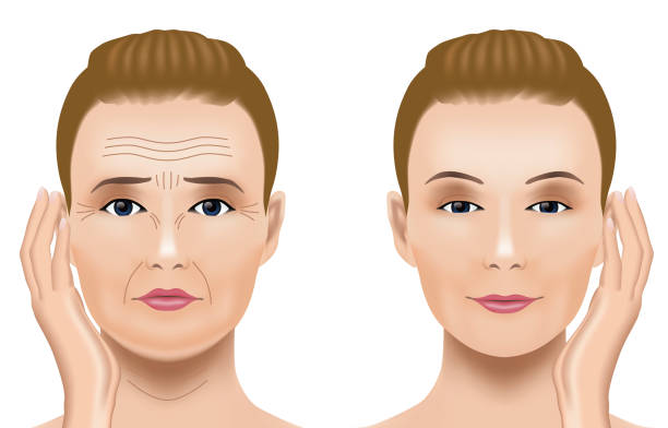 gesichtsfalten-behandlung vor nach. kosmetische chirurgie. frau-gesichtsbehandlung-konzept. - face lift illustrations stock-grafiken, -clipart, -cartoons und -symbole