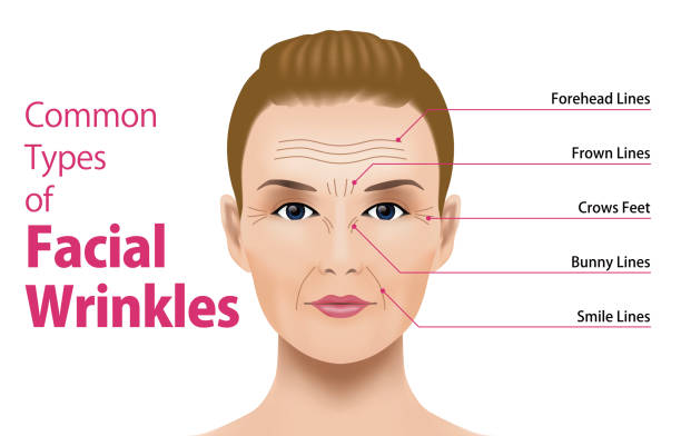 ilustrações, clipart, desenhos animados e ícones de tipos comuns de rugas faciais. cirurgia cosmética. conceito de tratamento facial de mulher. - face lift illustrations