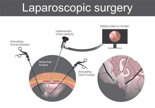 Laparoscopic surgery. Technical surgery which operations are performed far from their location through small incisions in abdominal surface or the body. Large Intestine system. Illustration human body parts. vector art illustration