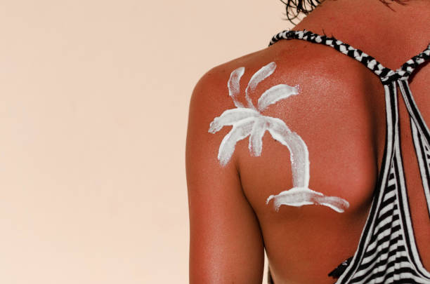 istock Sunburn woman skin 858766842