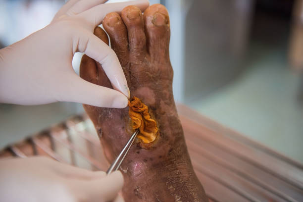 closeup  infection wound in the foot of patients closeup  infection wound in the foot of patients . infected wound stock pictures, royalty-free photos & images