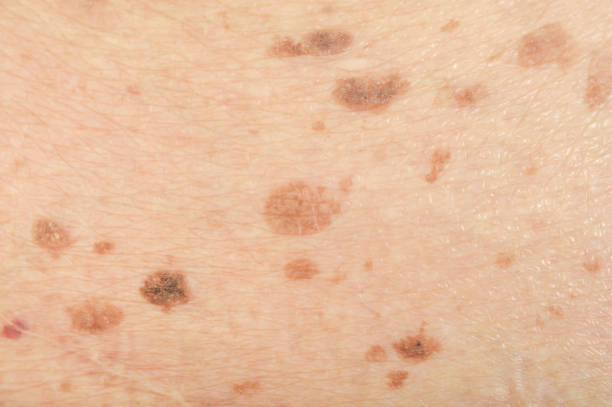 весну�шки на коже - freckle стоковые фото и изображения