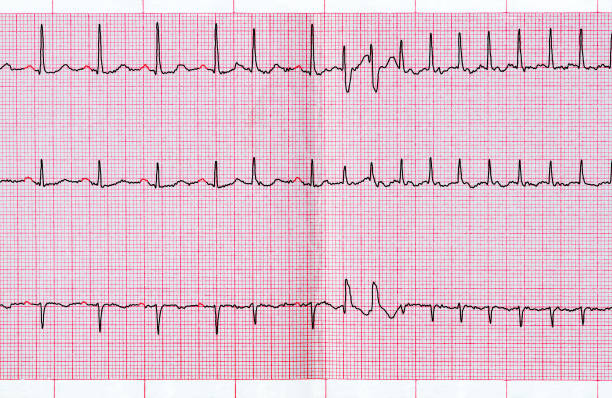 ecg con extrasístole supraventricular y breve paroxismo de la fibrilación auricular - fibrillation fotografías e imágenes de stock