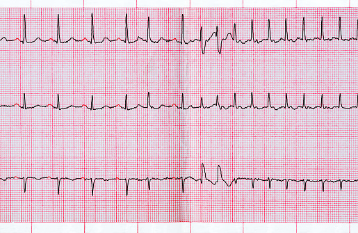Electrocardiogram / ECG printed on graph paper.