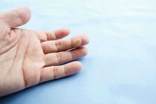 istock Blister caused by scald 860795118