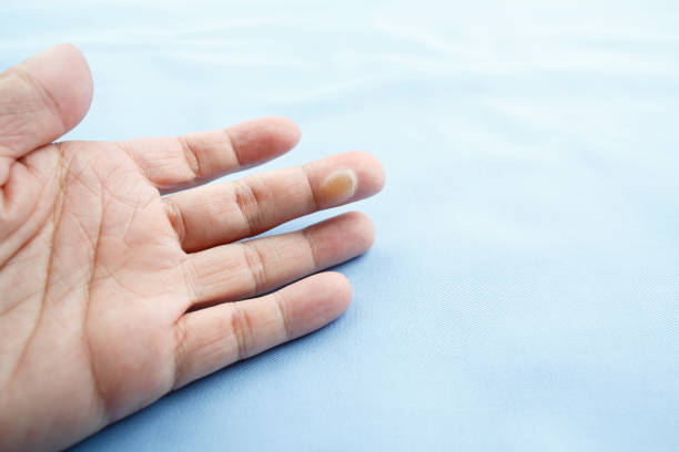 istock Blister caused by scald 860797446