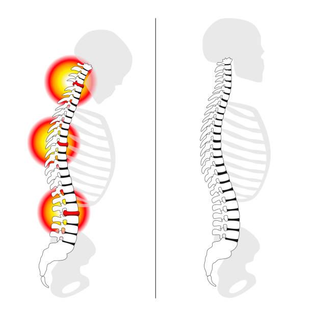 ilustraciones, imágenes clip art, dibujos animados e iconos de stock de prolapso de la hernia discal, curvado hacia atrás, severo dolor de espalda - vistas de perfil de herniation espinal del disco versus vertical espalda sana - aislados ilustración de vector sobre fondo blanco. - slipped disc