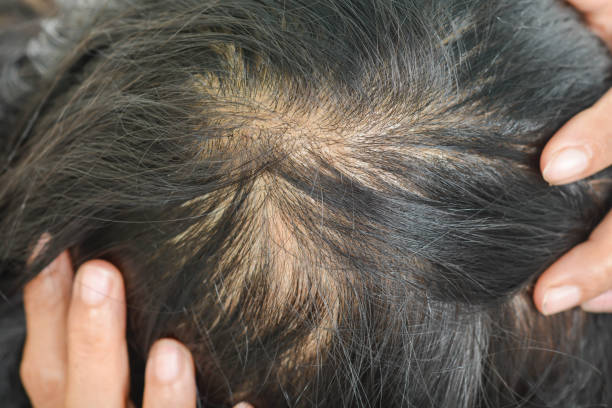 istock thin hair in women 861132414
