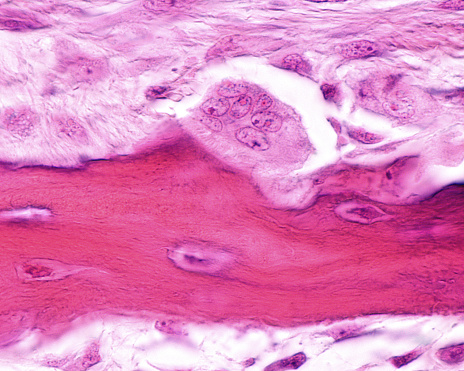 Developing bone showing an osteoclast located in its Howship’s lacuna. The osteoclast is a large multinucleated cell which shows a ruffled border at a site of active bone resorption. H&E