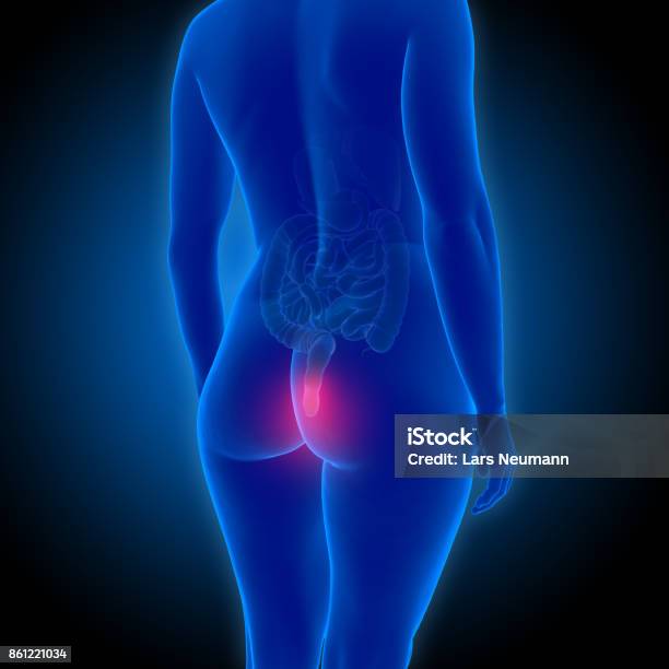 3d Illustration Showing Female Body With Haemorrhoids Stock Photo - Download Image Now