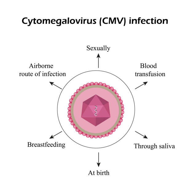 illustrazioni stock, clip art, cartoni animati e icone di tendenza di citomegalovirus. malattie causate dal citomegalovirus. infografica. illustrazione vettoriale - citomegalovirus