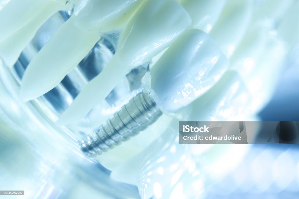 Dental Titan ästhetischen kieferorthopädischen Zahnimplantat im Mund Zahnärzte Zähne Modell Closeup isoliert. - Lizenzfrei Emaille Stock-Foto