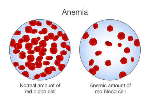 The difference of Anemia amount of red blood cell and normal. Illustration about medical.