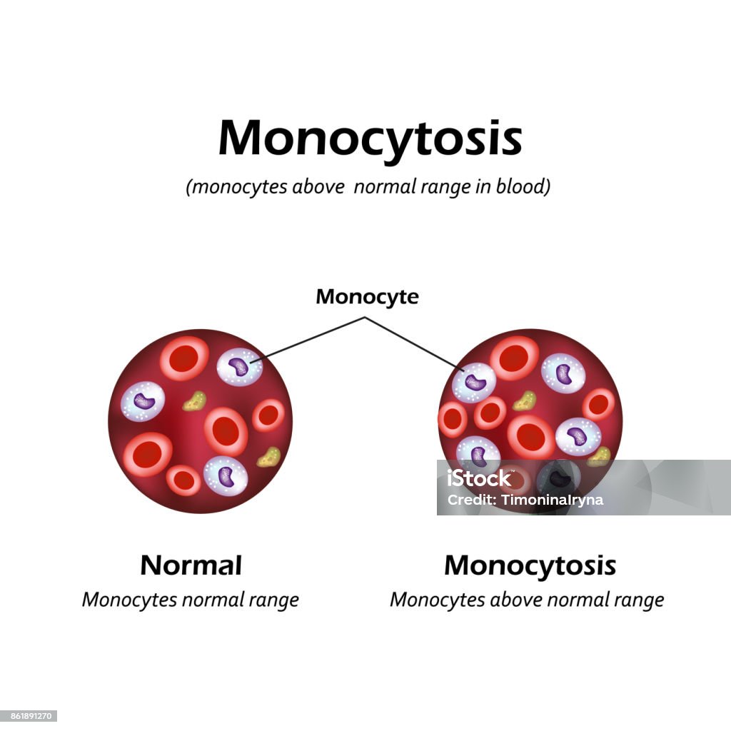 Monócitos acima do normal no sangue. Monocitose. Ilustração vetorial - Vetor de Anatomia royalty-free