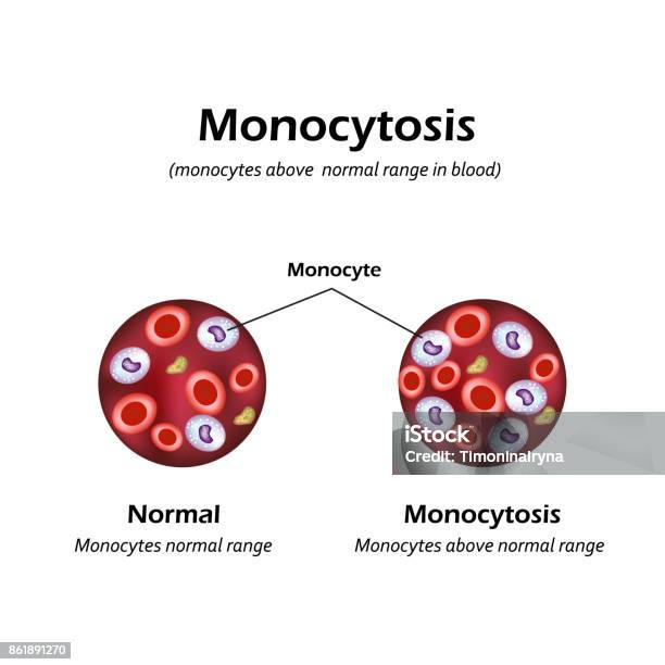 Vetores de Monócitos Acima Do Normal No Sangue Monocitose Ilustração Vetorial e mais imagens de Anatomia