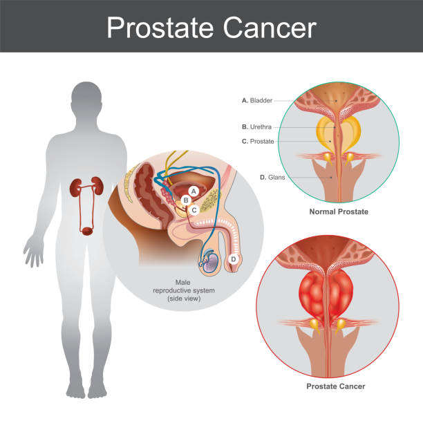 Prostate Cancer. Illustration anatomy body part. The Prostate cancer is the most common cancer among men not skin cancer. The Prostate cancer that starts in the prostate gland, which is a walnut sized gland at the base of the bladder in old men. Illustration anatomy body part. phallic object stock illustrations