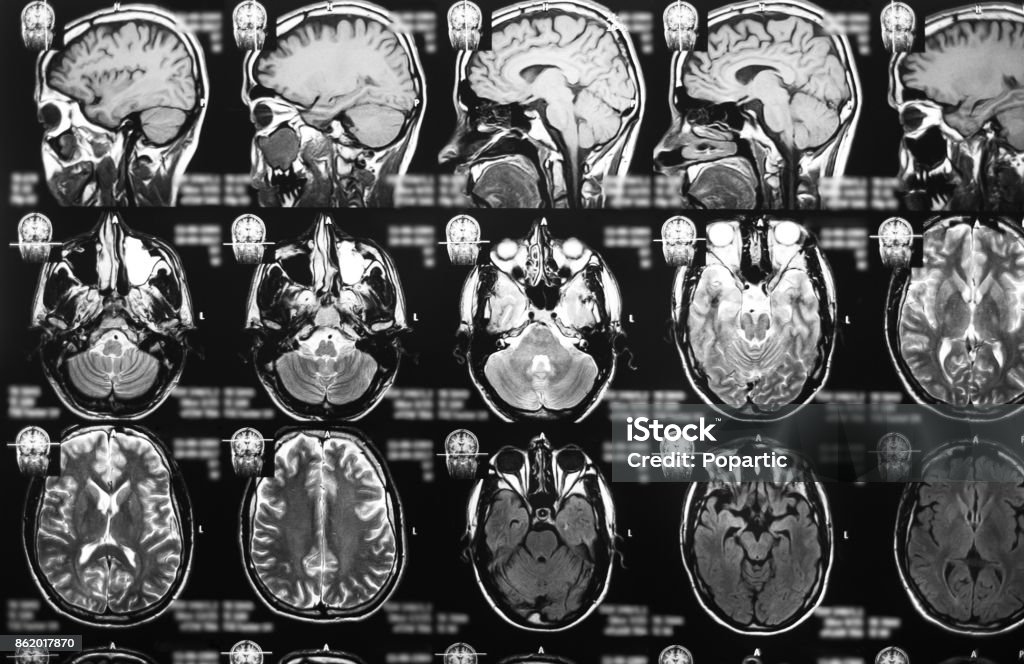 Magnetic resonance imaging Magnetic resonance scan of the brain. Medicine, science concept. Alzheimer's Disease Stock Photo