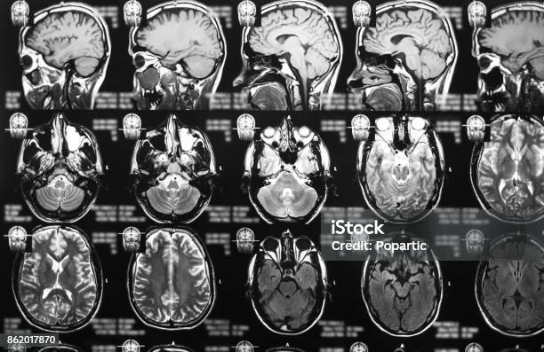 Magnetic Resonance Imaging Stock Photo - Download Image Now - Alzheimer's Disease, MRI Scan, Analyzing