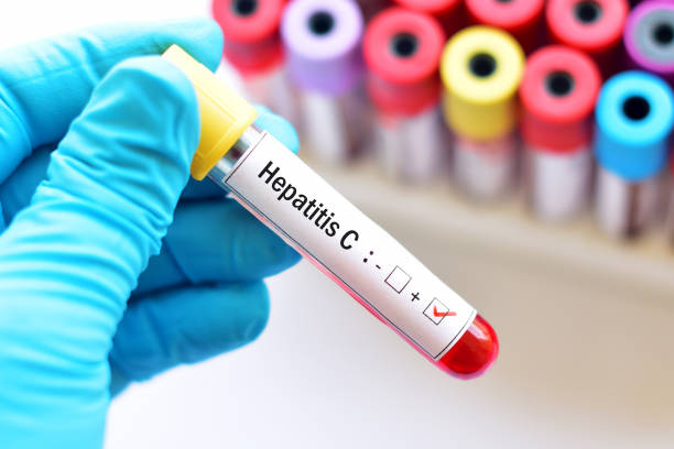 Hepatitis C positive stock photo