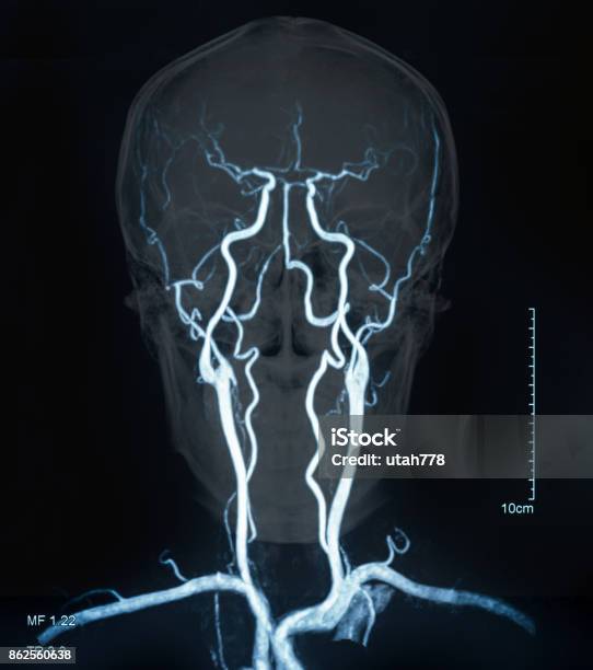 Mri Blutgefäße Im Gehirn Stockfoto und mehr Bilder von Halsschlagader - Halsschlagader, Blutkreislauf - Kardiovaskuläres System, Krankheit