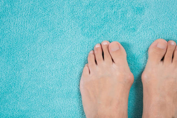 istock Hallux valgus, bunion in a leg on a blue soft background 863569554
