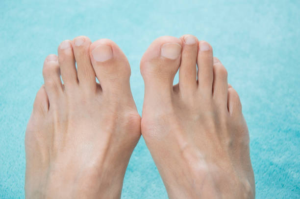istock Hallux valgus, bunion in a leg on a blue soft background 863569574