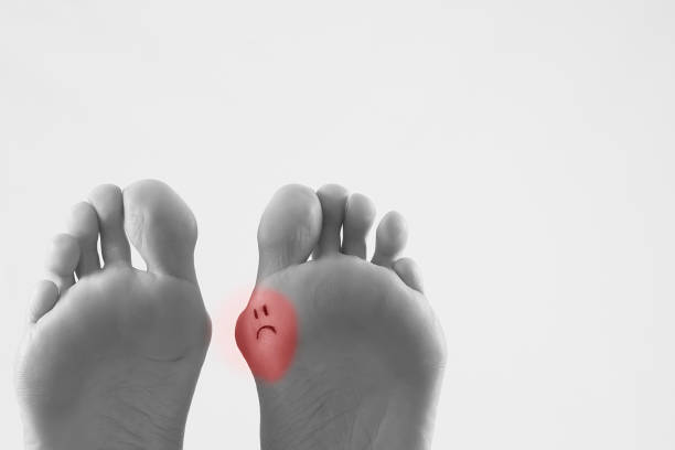 istock Hallux valgus, bunion in foot on white background 863569714