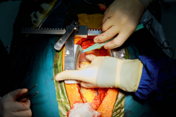 istock Beating human heart close-up in opened chest during the surgery 863624670