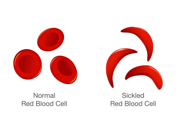 ilustraciones, imágenes clip art, dibujos animados e iconos de stock de la diferencia de los glóbulos rojos normales y células falciformes. - sickle cell anemia red blood cell blood cell anemia