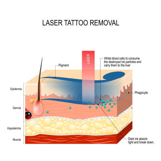 laserowe usuwanie tatuażu. - laser tattoo stock illustrations