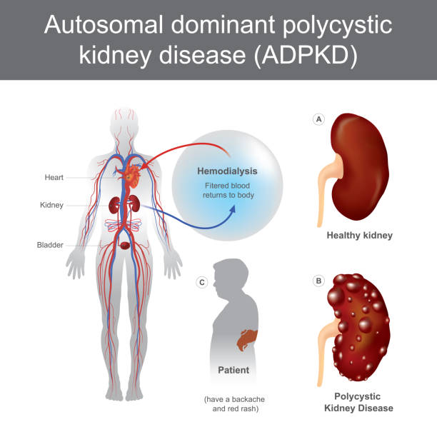 Autosomal Dominant Polycystic Kidney Disease. Have a backache and Acute loin pain, Enlargement of one or more cysts, renal colic, and Acute kidney failure. Medical examination. Illustration vector. kidney failure stock illustrations