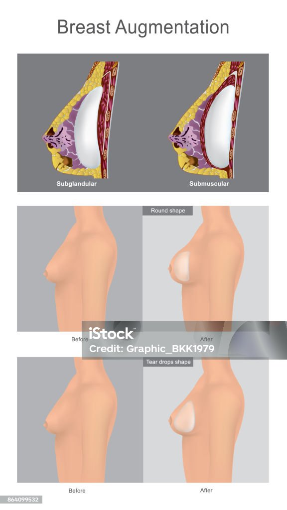 The Surgery Augmentation of the breast  using filled with saline-solution.
This is popular cosmetic surgery for women. Illustration anatomy body part. The Surgery Augmentation of the breast  using filled with saline-solution. Breast stock vector