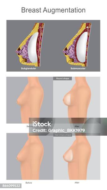 The Surgery Augmentation Of The Breast Using Filled With Salinesolution This Is Popular Cosmetic Surgery For Women Illustration Anatomy Body Part Stock Illustration - Download Image Now